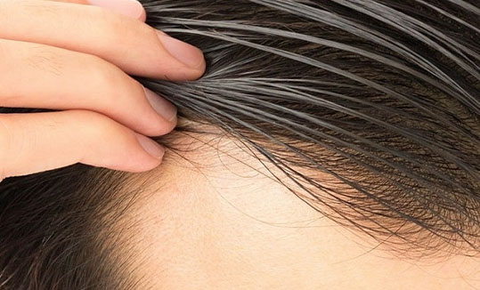 لیزر و کاشت مو ارشیا 