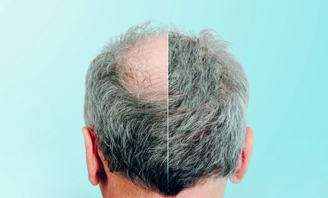 کلینیک کاشت مو درنیانی